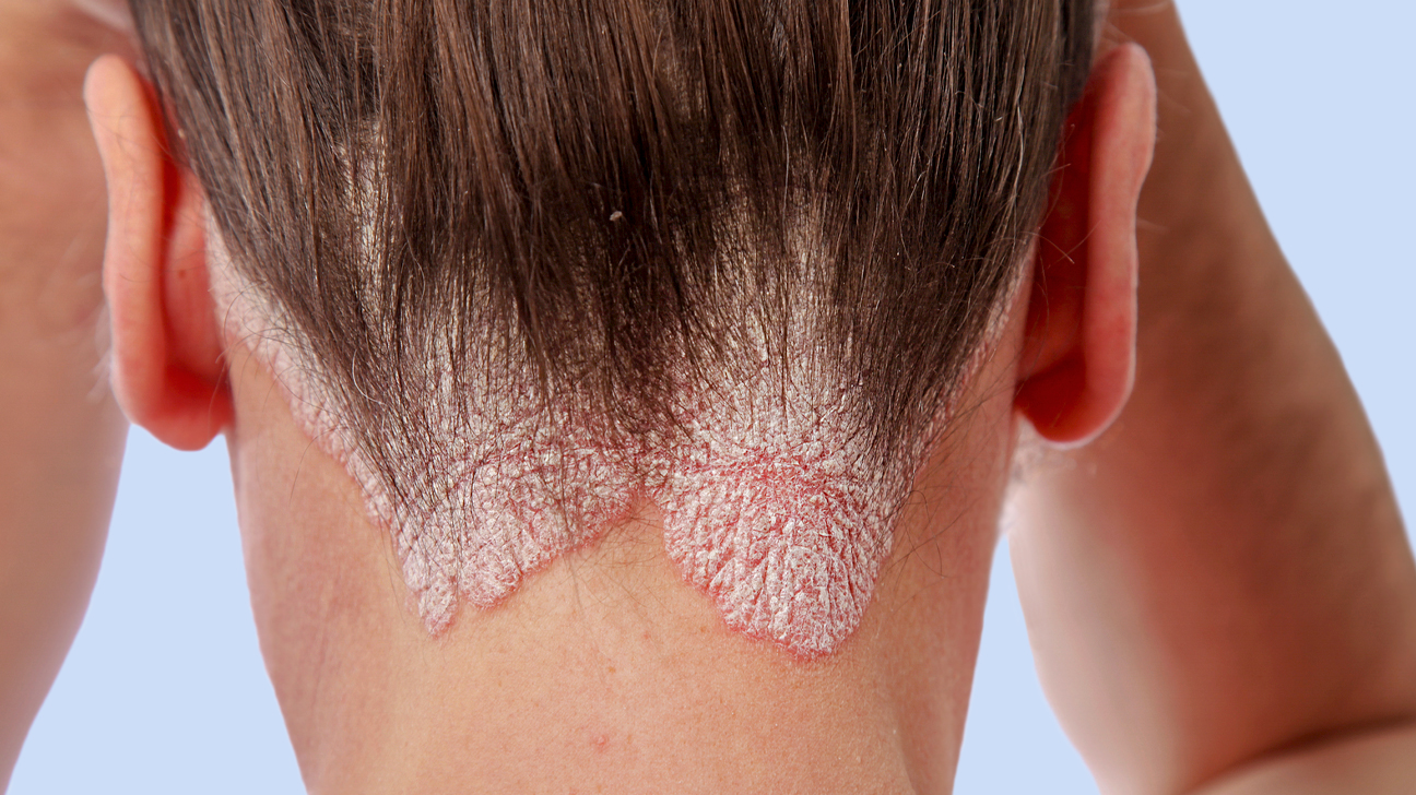Scalp psoriasis can be difficult to diagnose because many skin conditions can look similar to it.
Christine Langer-Püschel/Getty Images