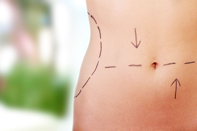 Tummy tuck