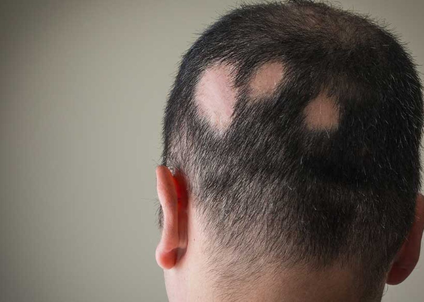 Alopecia