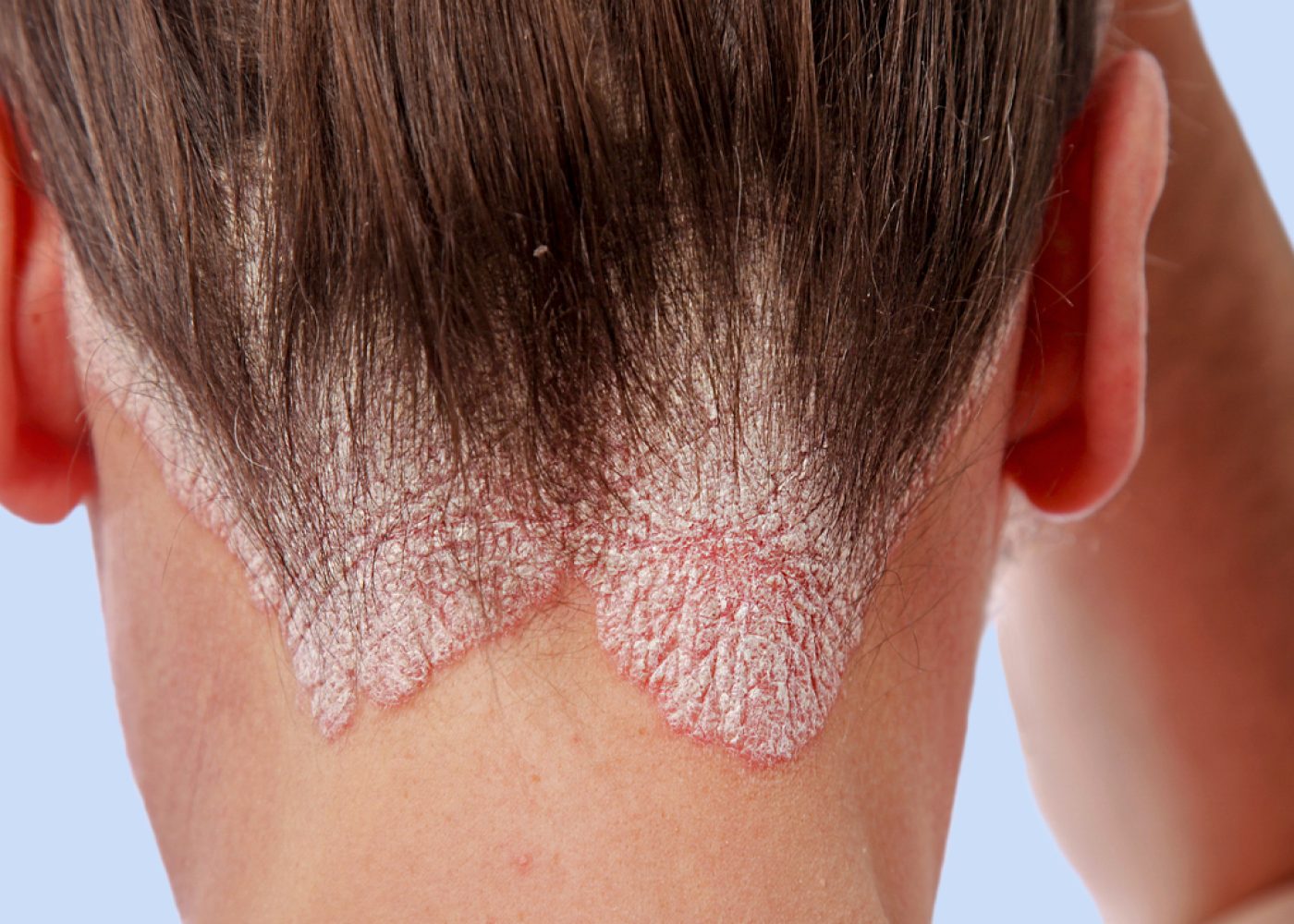 Scalp psoriasis can be difficult to diagnose because many skin conditions can look similar to it.
Christine Langer-Püschel/Getty Images