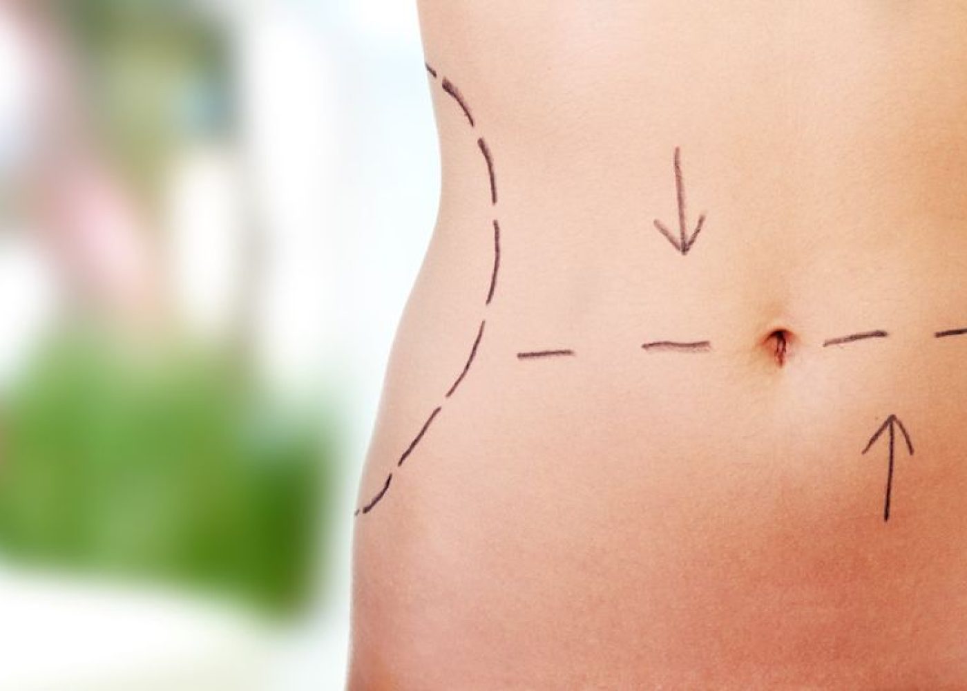 Tummy tuck